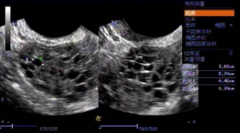 多囊卵巢患者试管6次，终于在王蔼明主任调理下成功怀孕！