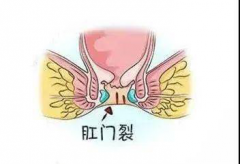 呼和浩特市东大肛肠医院：肛裂为什么会这么痛？