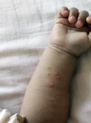 正确认识手足口病 高发期不再慌张