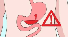 呼和浩特东大肛肠医院：胃出血有多危险？4大发病原因要警惕