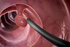 【襄阳胃肠医院哪家好】胃息肉是胃癌的前兆吗？