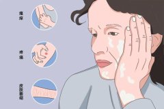 	沈阳看白癜风医院哪家专业？日常如何护理？