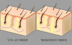 沈阳腋臭治疗就来肤康