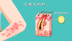 沈阳慢性毛囊炎怎么治疗？沈阳肤康怎么样？